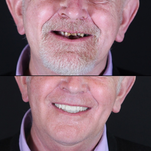 dental implants (Veneers vs Implants)