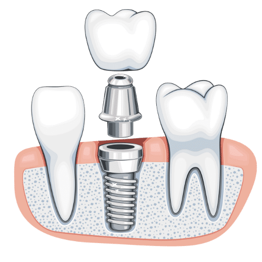 Cost Of Full Mouth Dental Implants